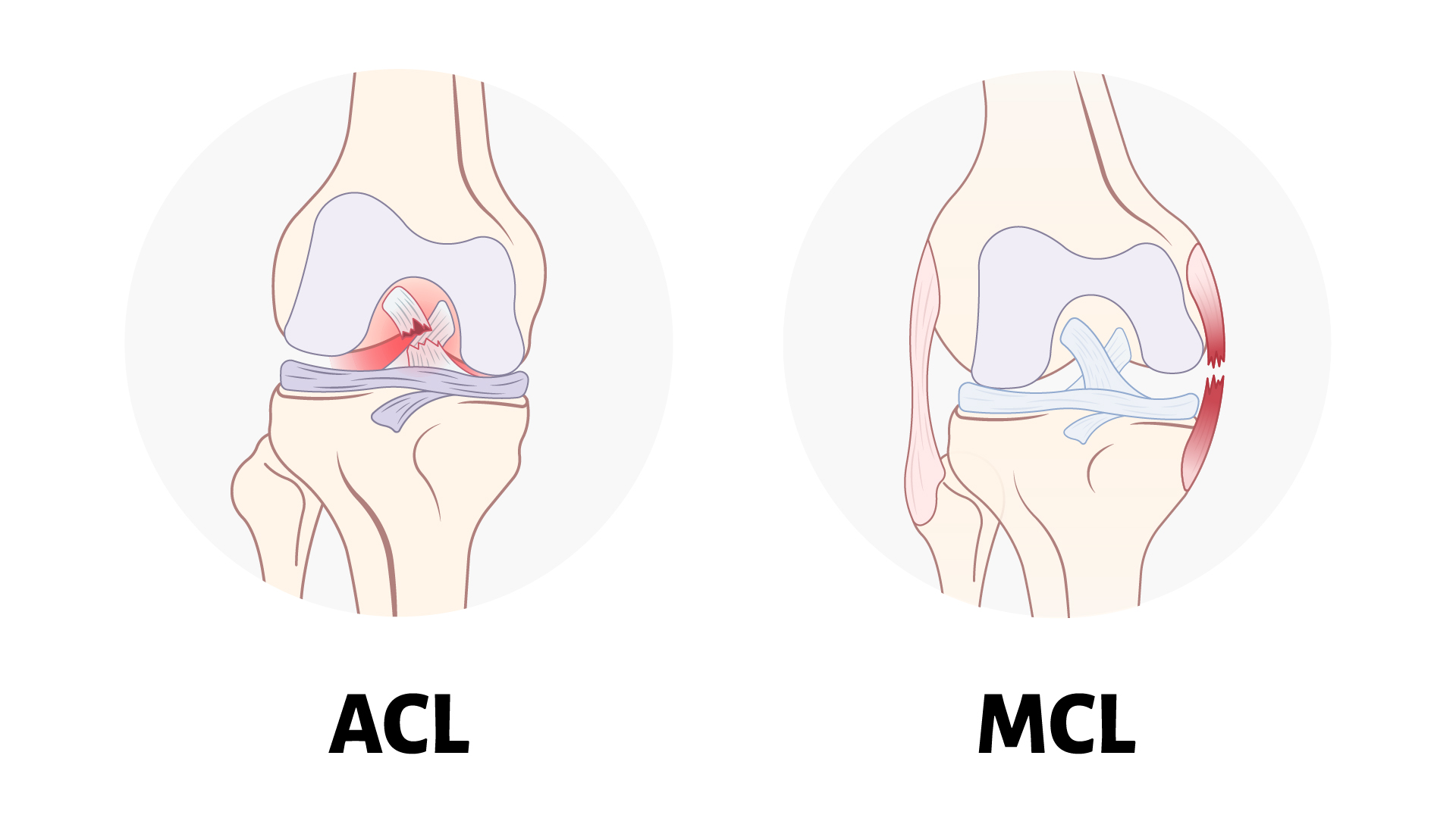 The Difference Between an ACL & MCL Tear